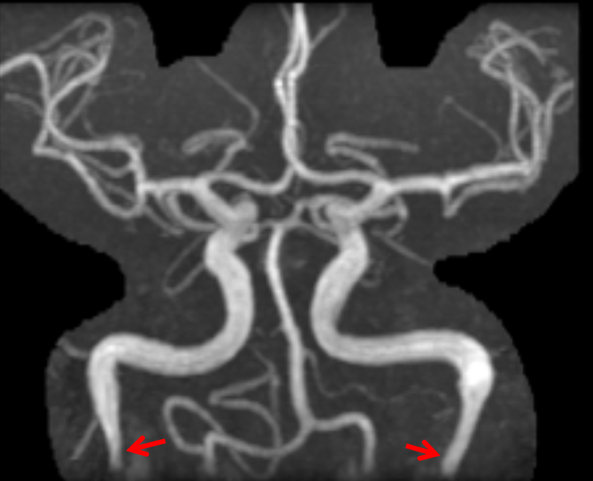 Carotid Artery Stenosis Pulsatile Tinnitus